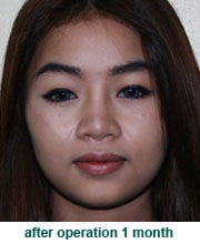 plastic_surgery_augmentation_rhinoplasty